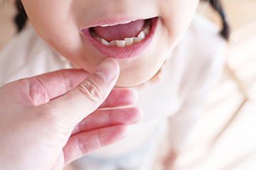 お子さまの成長に合わせた矯正治療